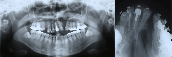 口唇口蓋裂の治療例　左側唇顎口蓋裂に起因する顔面非対称を呈する骨格性下顎前突　顎裂部骨移植直前　パントモ＋上顎咬合法Ｘ線写真
